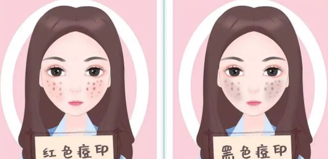 臉上紅色痘印幾個月都不消怎么辦?紅色痘印應該怎么消除?