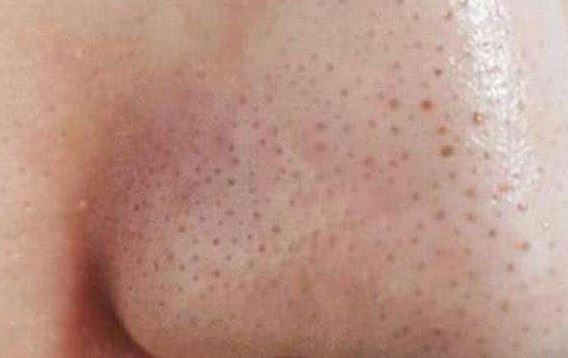 清潔面膜哪個(gè)牌子可以快速祛黑頭?趙薇、薇婭 推薦的紐西之謎泥膜真的好用嗎?